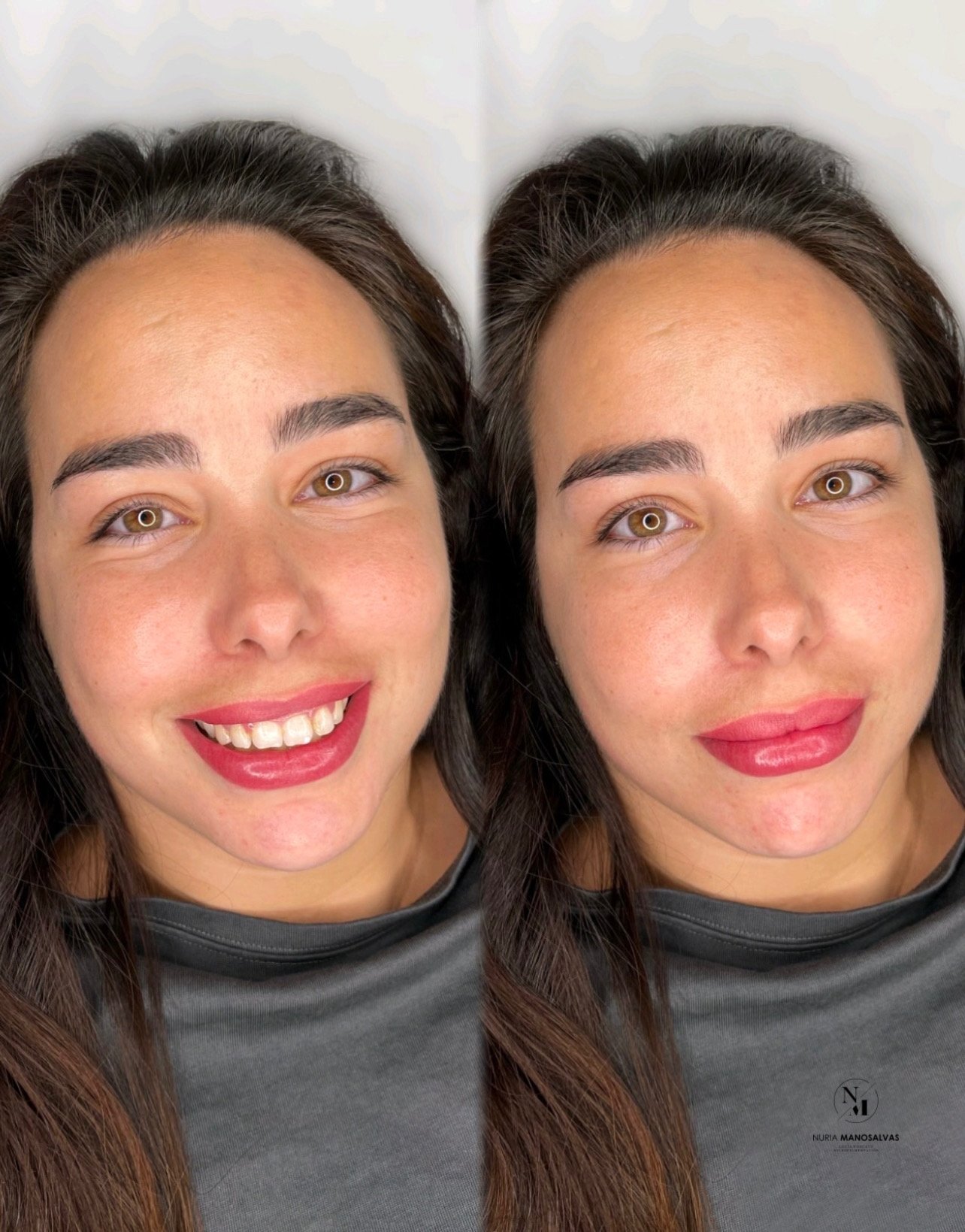 labios antes despues
